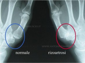 rizartrosi